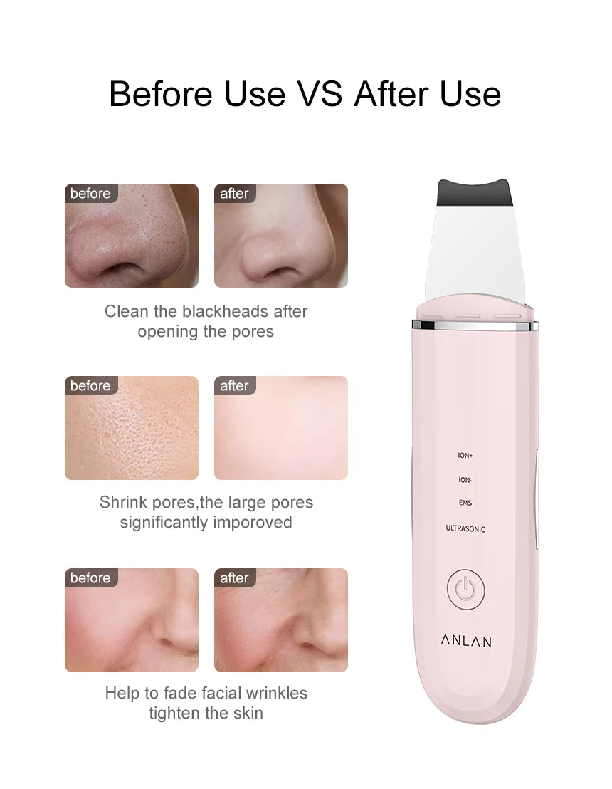 ANLAN Ultrasonic Skin Scrubber Facial Cleansing Device