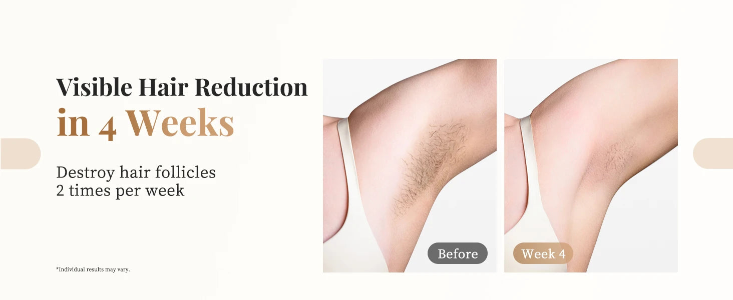 Totmizby 3-in-1 IPL Laser Hair Removal Device – Painless Home Epilator - Roomsium